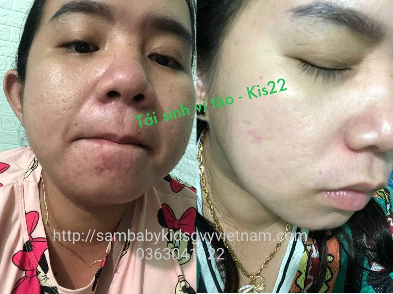 Review tái sinh da siêu vi tảo green vita Review tái sinh da siêu vi tảo green vita