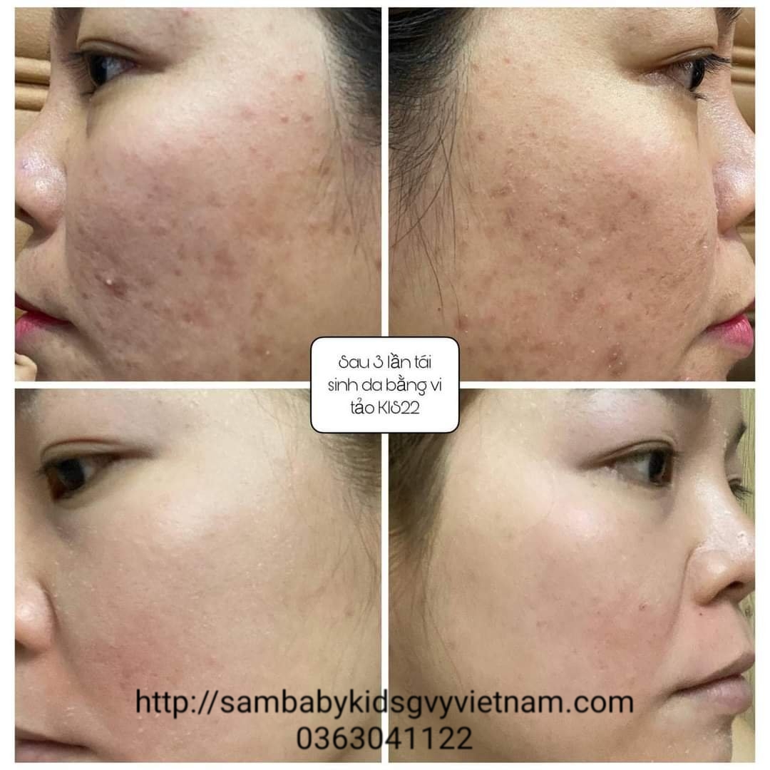 Tái sinh da siêu vi tảo kis22